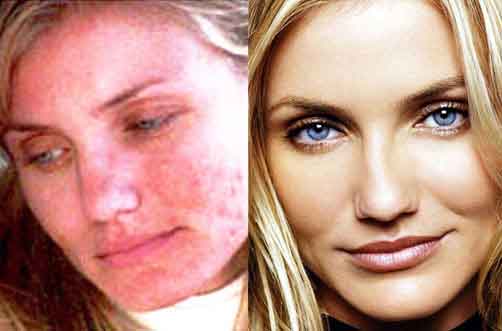 El cuidado de la cutis problemática después de 40 años