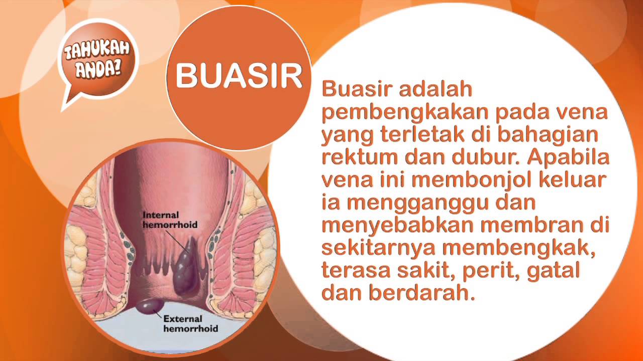 Ubat Buasir Dispiles Buasir Apakah Penyakit Itu