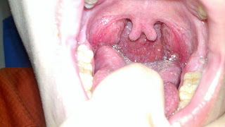 Simple Way To Get Rid Of Tonsil Stones : The Lowdown On Gonorrhea