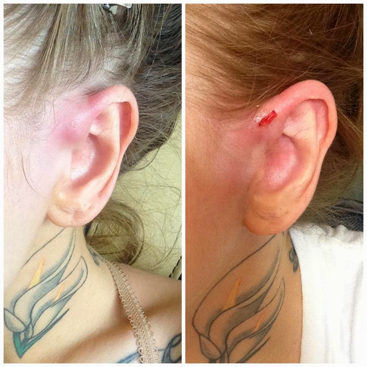 34+ Preauricular Ear Pit Infection Images