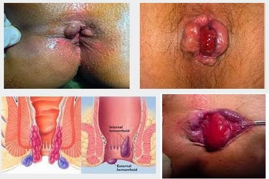 obat wasir yang manjur, obat wasir, pengobatan wasir