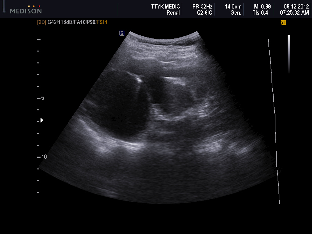 Renal Ultrasound Hydronephrosis