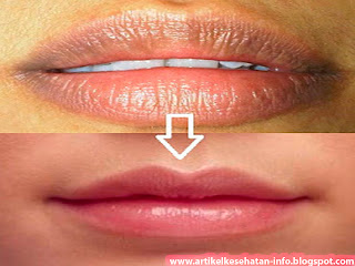 Cara Mengatasi bibir hitam