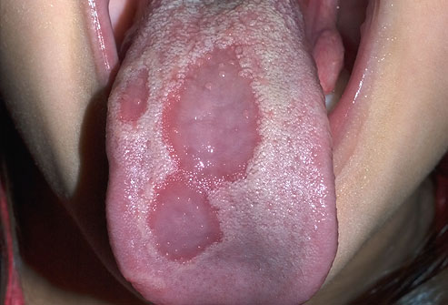 Blister On Tongue