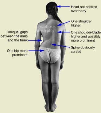 my birding field trips posterior spinal fusion for scoliosis or spine surgery my birding field trips posterior spinal fusion for scoliosis or spine surgery