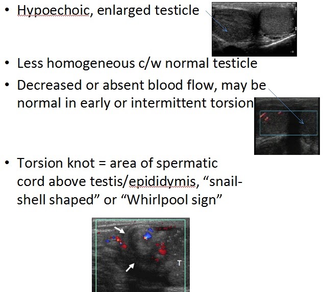 THE A.D.D. E.D. ultrasound in testicular torsion