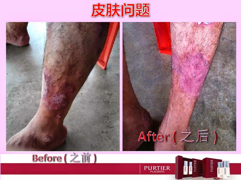 SKIN DISEASE (PSORIASIS/ACZEMA/CUTANEOUS CONDITION)