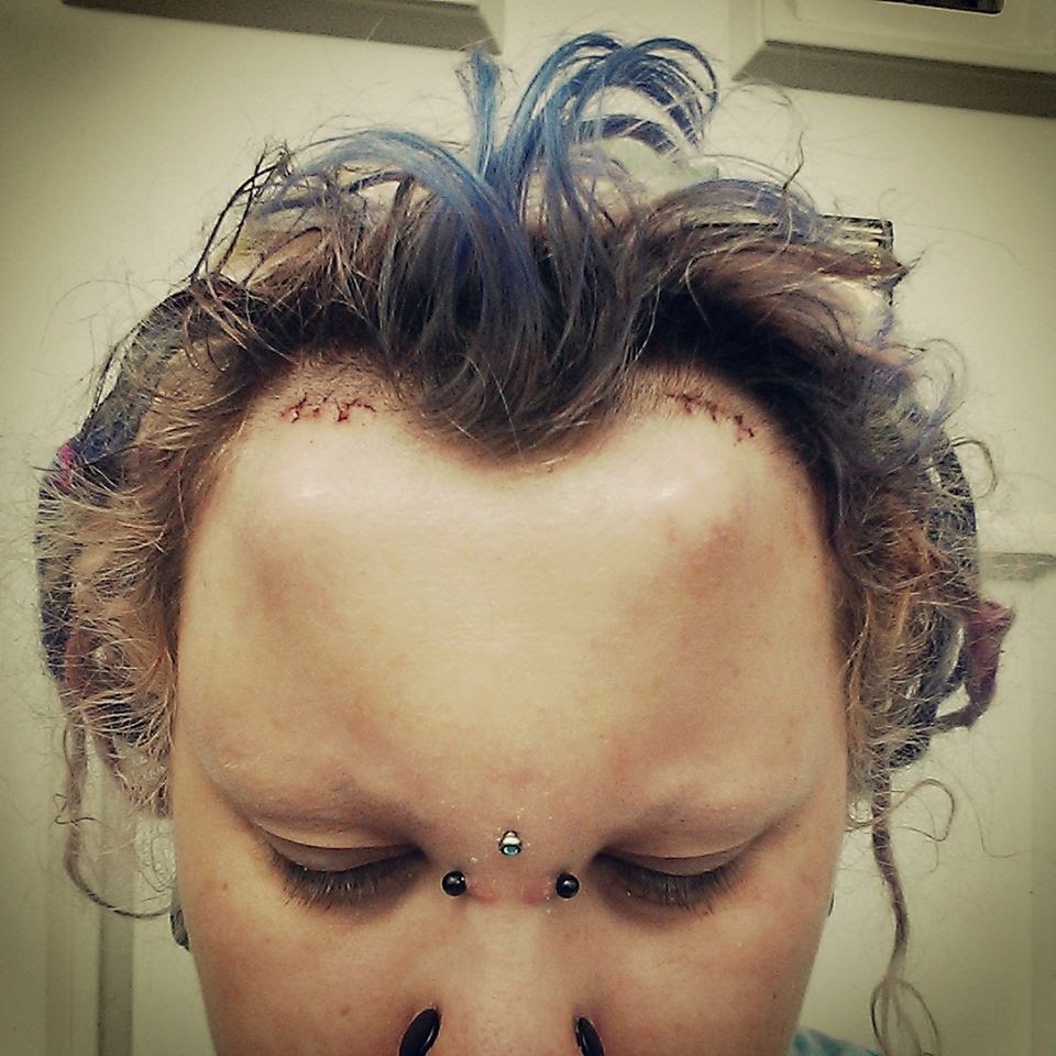 Olive Elf Sub dermal horn implants! Healing / procedure