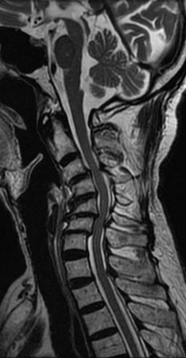 Cervical Kyphotic Deformity