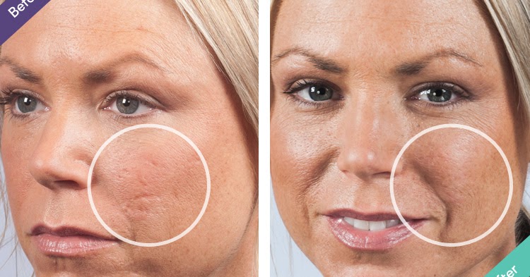 pimples on private parts female home remedies pimples on private parts female home remedies