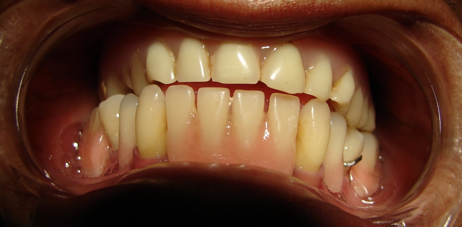 Reabilitação Oral Caso Clínico Odontoflex superior + Roach