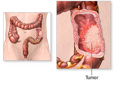 Colon Pain