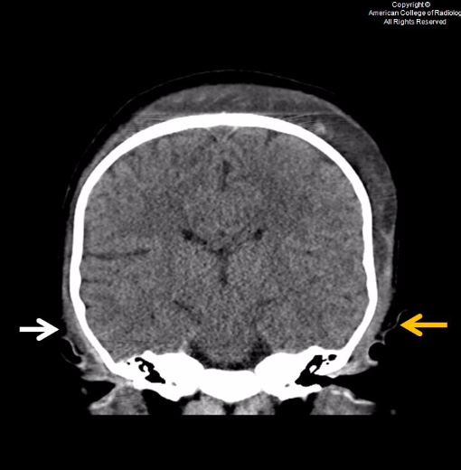 radiology image spotters subgaleal hemorrhage subgaleal hemorrhage