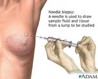 Fine needle biopsy 