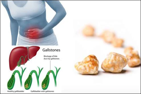 10 điều cần biết về bệnh sỏi mật mà bạn không thể bỏ qua