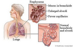 Emphysema