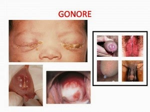 obat gonore yang manjur dan ampuh, obat alami gonore dari dokter, obat menyembuhkan gonore