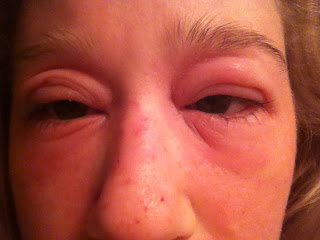 Topical steroid withdrawal red face