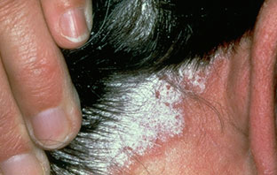 Esteroides topicos dermatologia