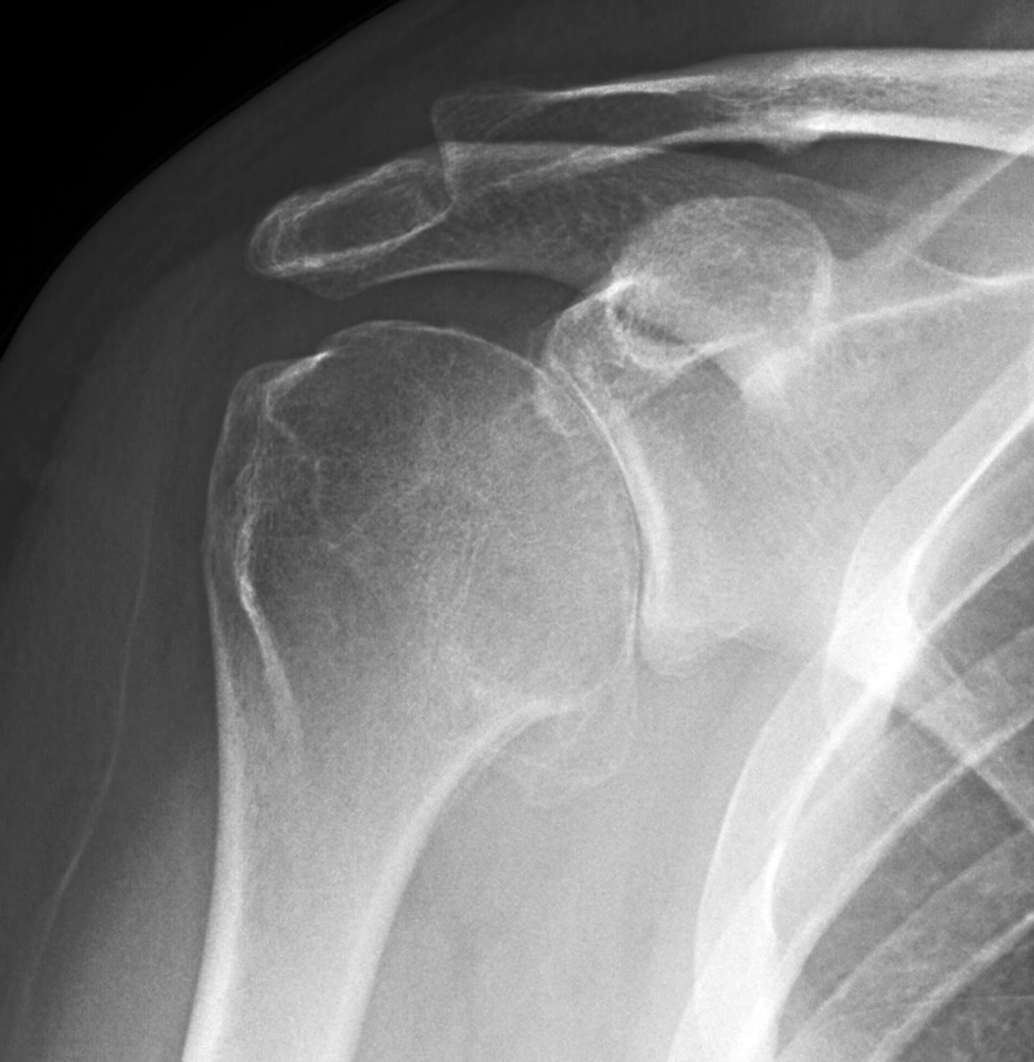 Shoulder Arthritis / Rotator Cuff Tears causes of shoulder pain How