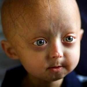 Progeria Causes Early Death