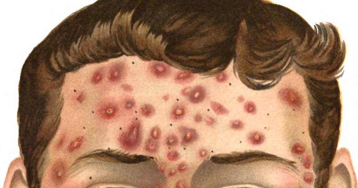 Cure for Cystic Acne