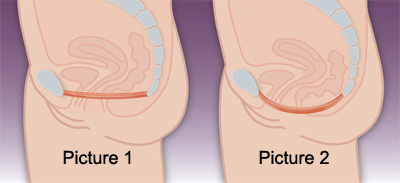 Living With A Colostomy Pelvic Floor Exercises For Reversal Surgery