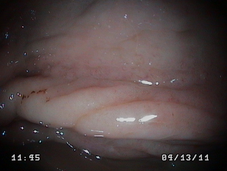 GASTROSCOPIA EN UN PERRO. GASTRITIS. GASTROSCOPY IN A DOG Cirugía