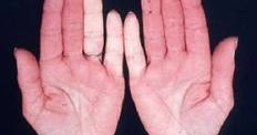 Boli Tratamente Remedii Lucruri Interesante Pentru Oricine Evolutia Bolii Raynaud