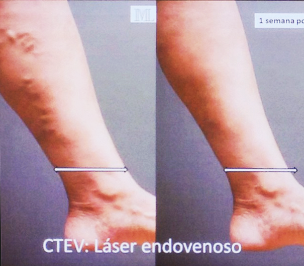 Elimina las varices con Láser Endovenoso con IML