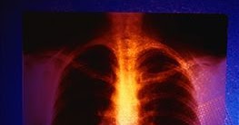 pneumonia bilateral signs