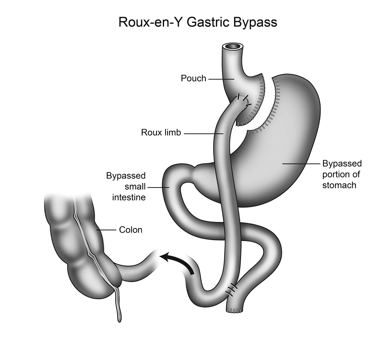 Roux En Y Gastric Bypass Surgery Complications Risks vrogue.co