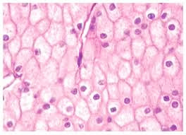 imagen Carcinoma renal de celulas cromofobas