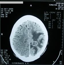 mri scan images of brain tumor image real pictures