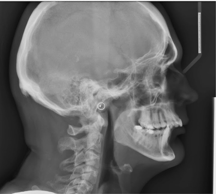 Double Jaw Operation The Road to Recovery
