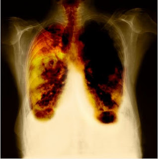 asbestos-dreadful_cancer-mesothelioma_symptoms_diagnosis_cure_mesothelioma_death_toll