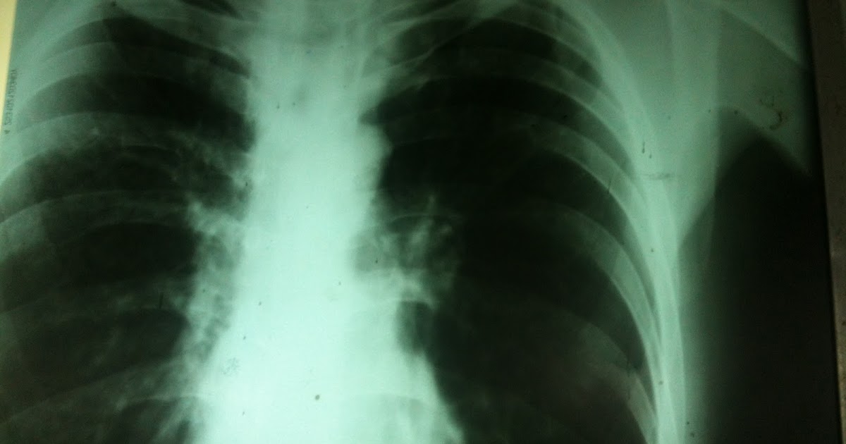Aeymon's Medical Life Lung Xray of an Asthma patient