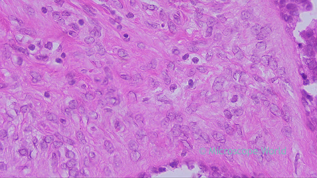 Breast benign tumor under the microscope at 400x.