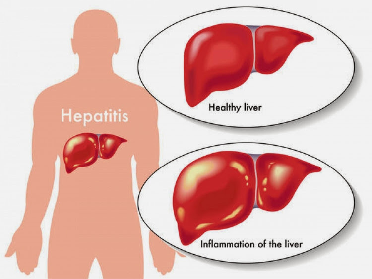 la hepatitis