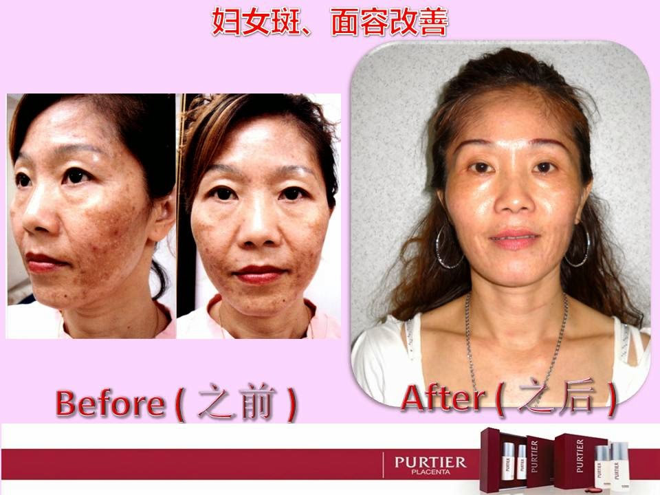JESSIE FANG (53 YEARS OLD) FACE PIGMENTATION