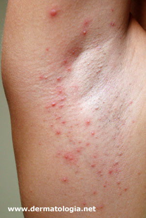 Tratamento de borbulha de acne em um nitrogênio de cara