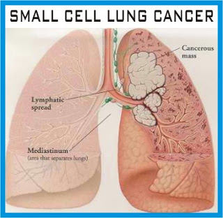 What is small cell lung cancer?