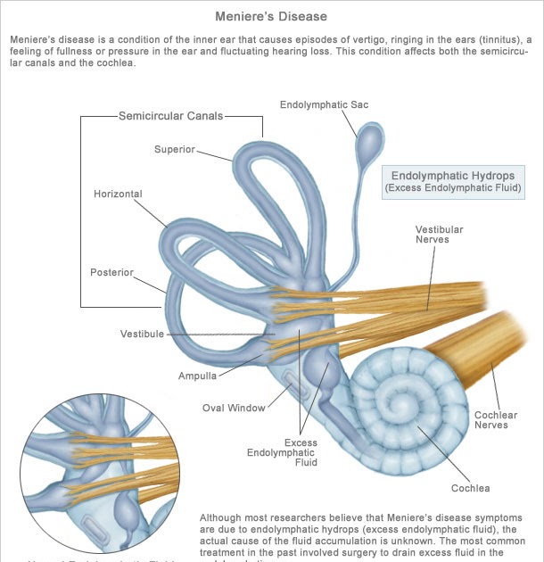 Free For Health Meniere's Disease Treatment With Homeopathy