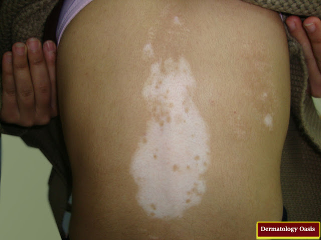 Vitiligo Treatment Malaysia : Info About Skin Disease Vitiligo