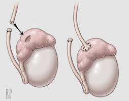 reversal surgery reversal procedure