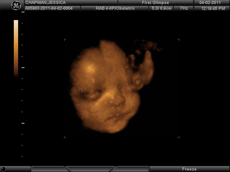 3d ultrasound pictures at 26 weeks. Here are my 3D/4D Ultrasound-