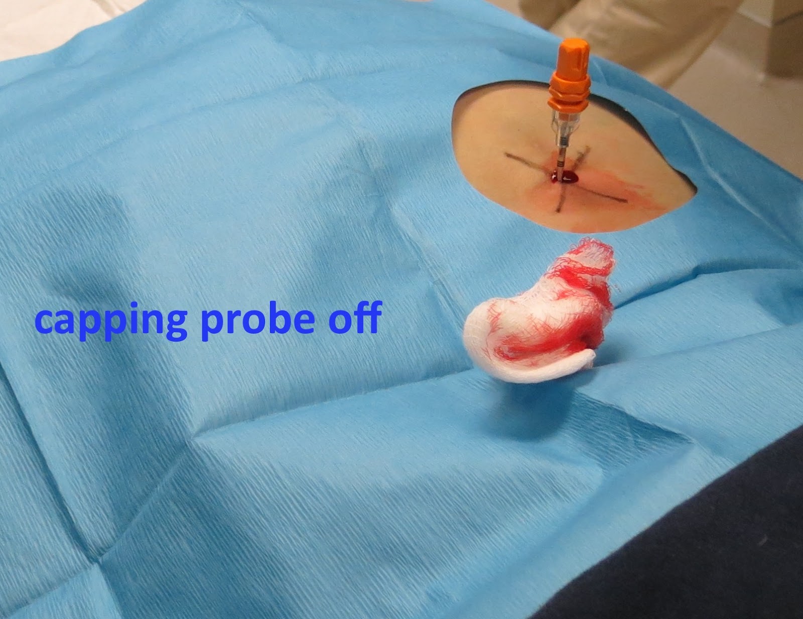 Bone marrow test price picture