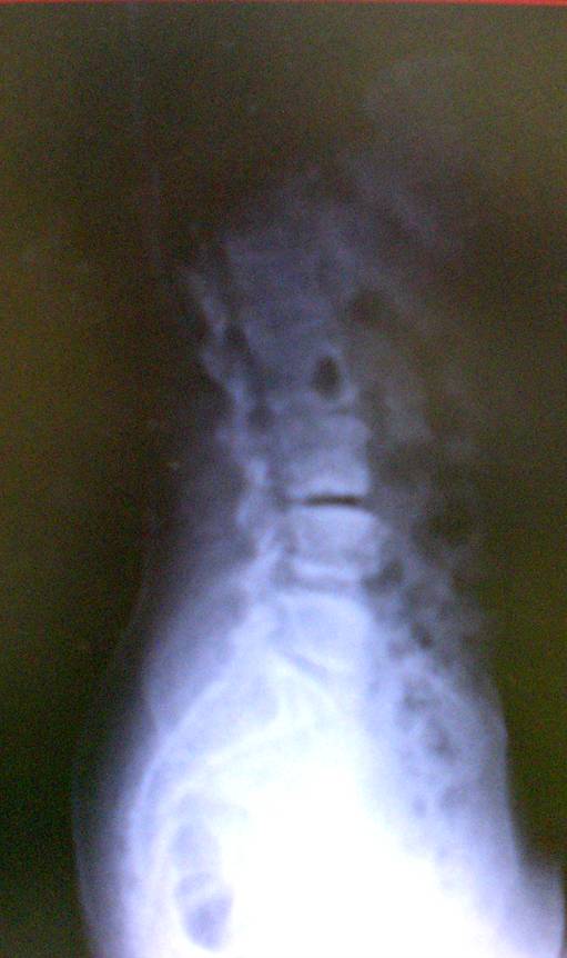 Phimaimedicine 1,324. Vacuum disc sign