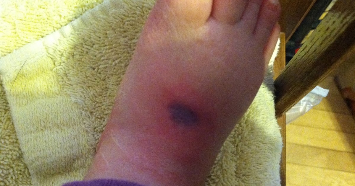 Rachel's Journey with Spina Bifida Pressure Sores from Casts