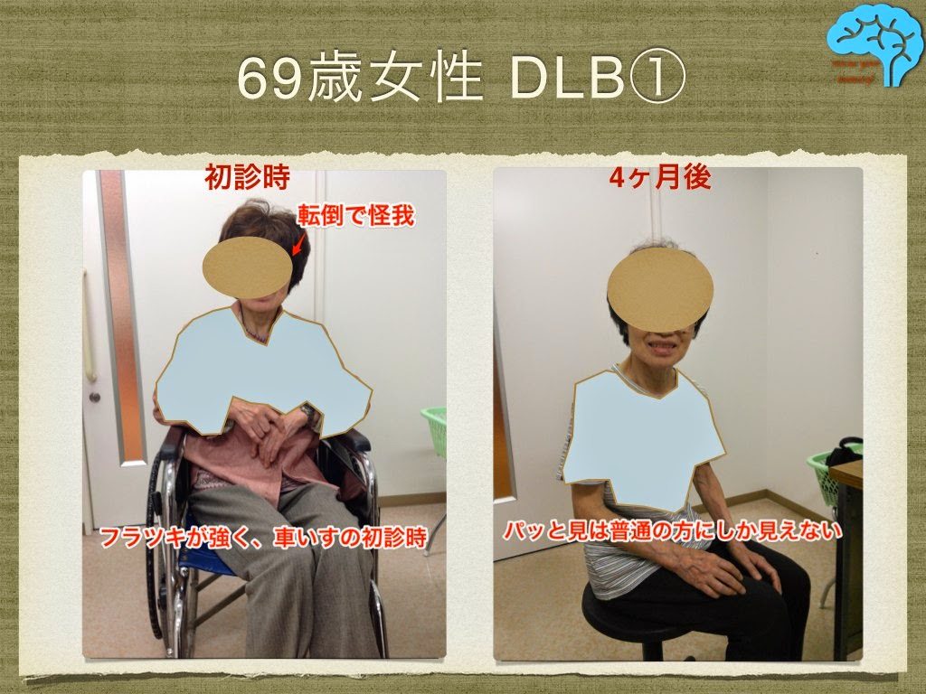 レビー小体型認知症の方がほぼ治ってしまった